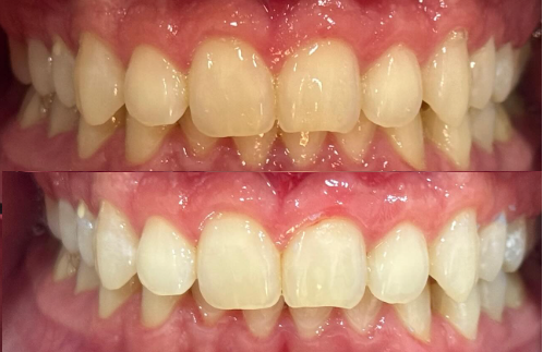 Blanqueamiento Dental