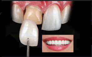 Diseño de sonrisa